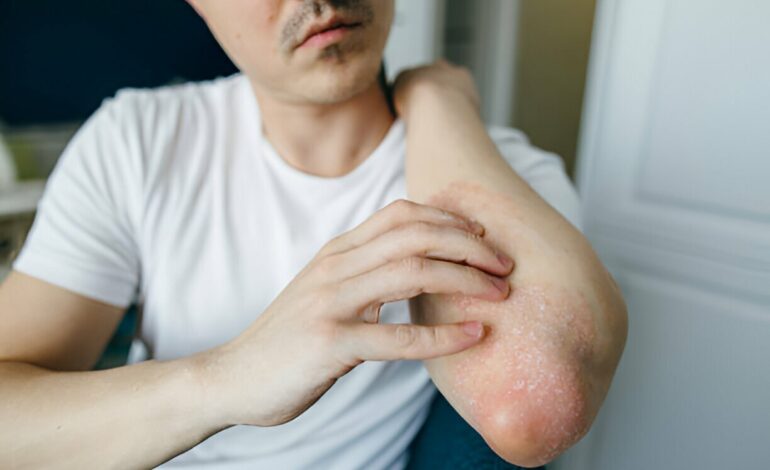 Ocean healed my eczema